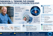 Parkinson, il tremore può spegnersi in pochi minuti: la rivoluzione degli ultrasuoni focalizzati che raggiungono il cervello senza aprire il cranio